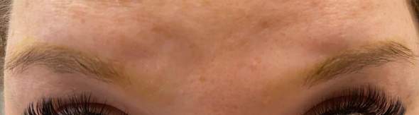Was Tun Bei Gelben Ruckstanden In Der Haut Nach Laserbehandlung Lasern Lassen