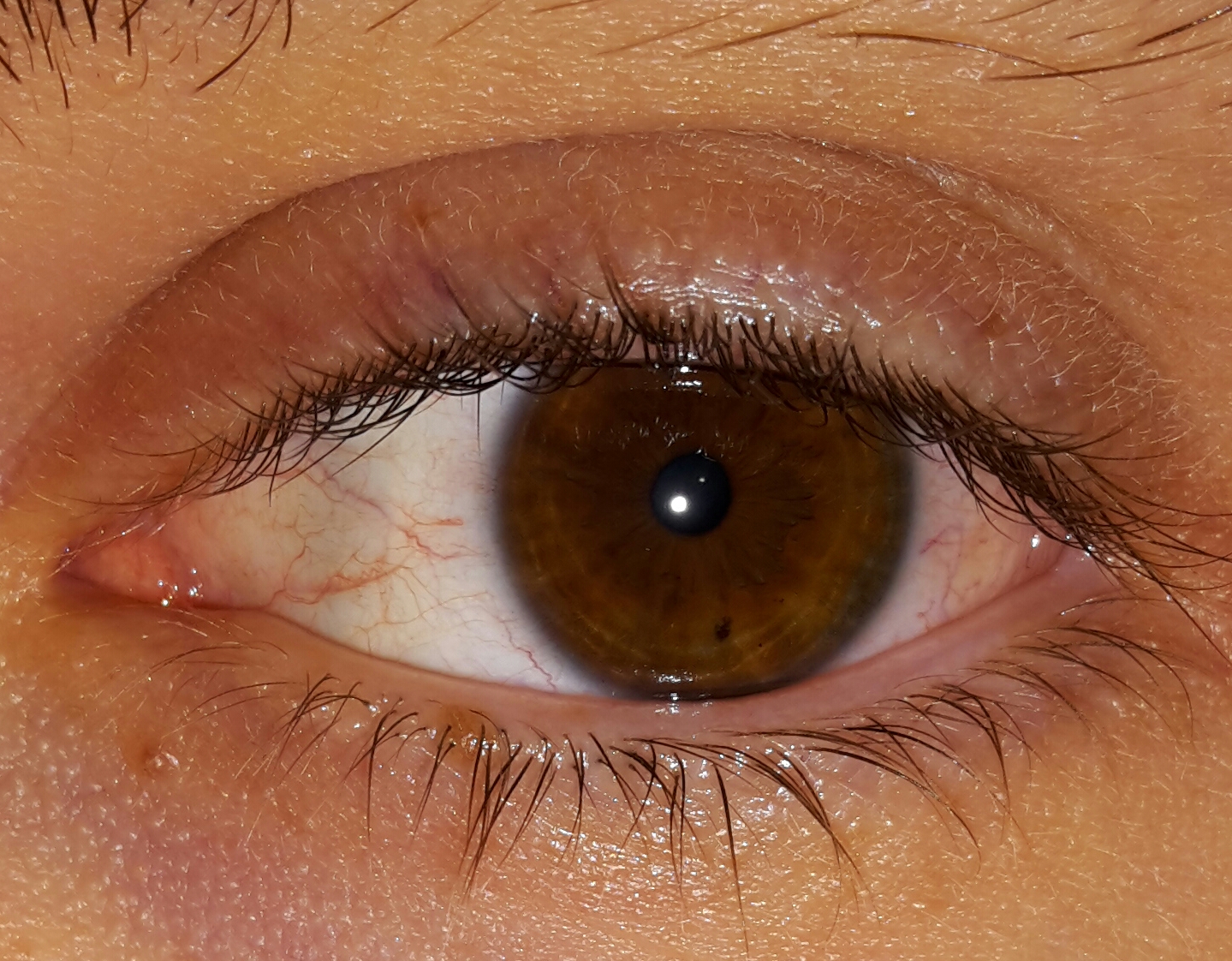 Was tun bei schwarzem Fleck in der Iris? (Medizin, Augen, Optiker) Was tun bei schwarzem Fleck in der Iris? (Medizin, Augen, Optiker)