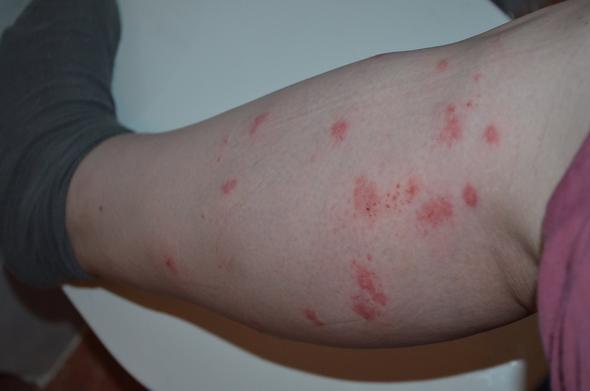 Was Tun Bei Solchen Wunden Muckenstich Aufgekratzt Haut Apotheke Wunde