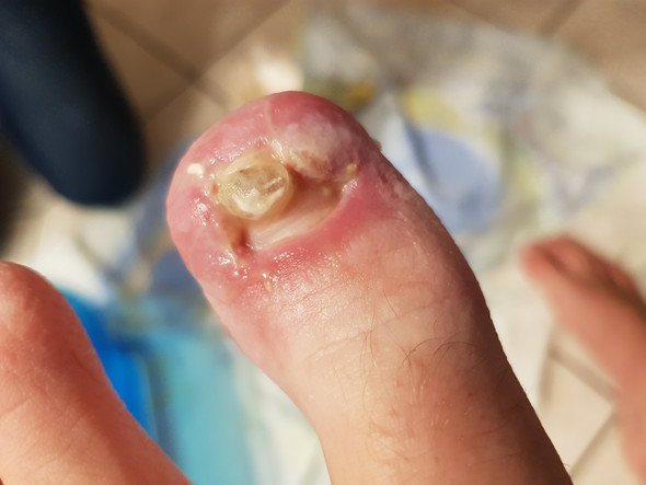 Was Tun Bei Wildem Fleisch Unguis Incarnatus Gesundheit Und Medizin Schmerzen Wildes Fleisch Was Tun Bei Wildem Fleisch Unguis Incarnatus Gesundheit Und Medizin Schmerzen Wildes Fleisch