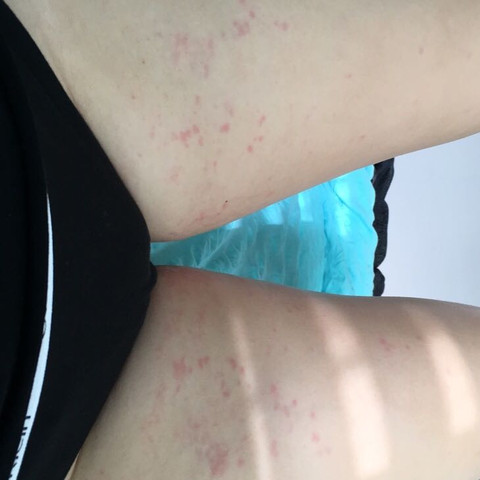 Was Tun Gegen Ausschlag An Den Beinen Medizin Pickel Beine Was Tun Gegen Ausschlag An Den Beinen Medizin Pickel Beine