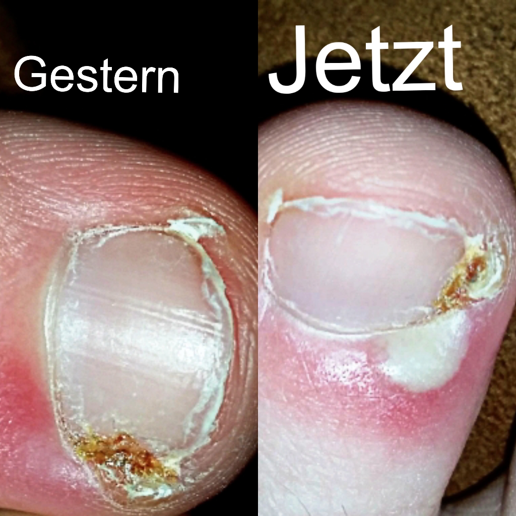 Was tun gegen ein Entzündeten Zeh?:( (entzündet)
