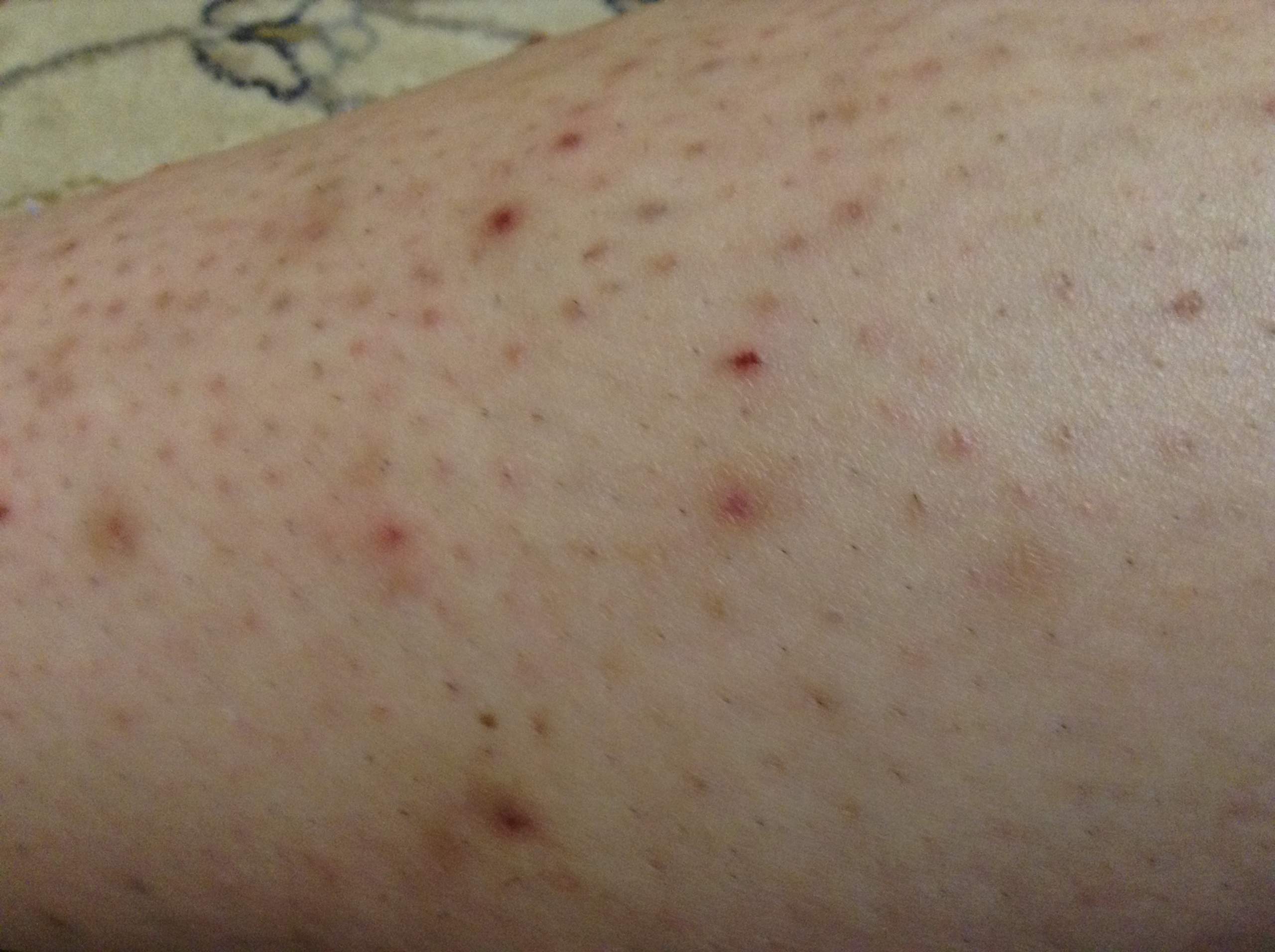 was tun gegen eingewachsen Haare und Pickel ? (Gesundheit und Medizin, Narben)