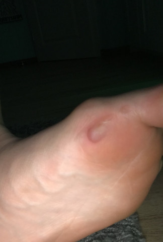 Was Tun Gegen Heftige Blase Am Fuss Fusse Was Tun Gegen Heftige Blase Am Fuss Fusse