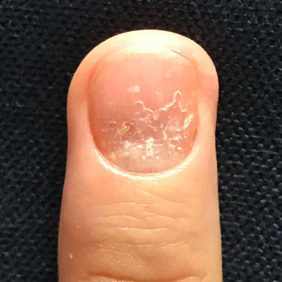 Fingernägel Gel Was Tun Gegen Kaputte Nägel? (gesundheit Und Medizin