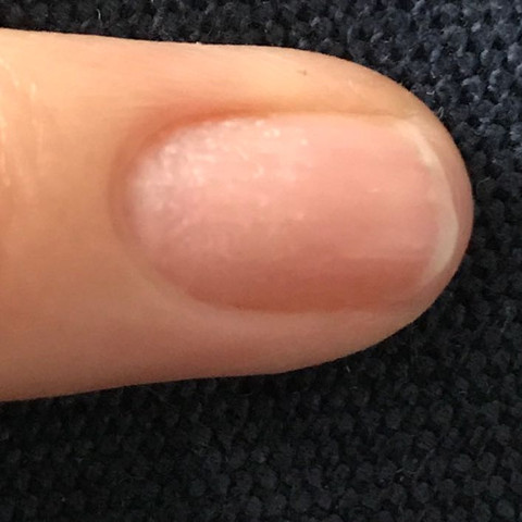 Der kleine Finger ist eher unauffällig betroffen. - (Gesundheit und Medizin, Gesundheit, Medizin)