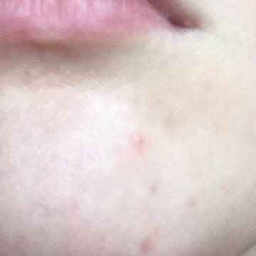 Was Tun Gegen Pickel Rotungen Hilfe Liebe Internet Gesundheit Und Medizin