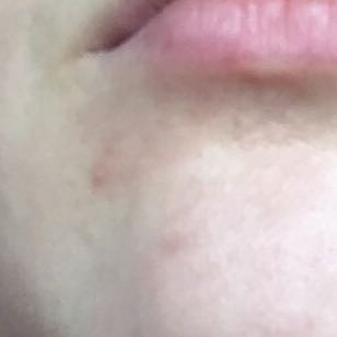 Was Tun Gegen Pickel Rotungen Hilfe Gesundheit Und Medizin Liebe Internet Was Tun Gegen Pickel Rotungen Hilfe Gesundheit Und Medizin Liebe Internet