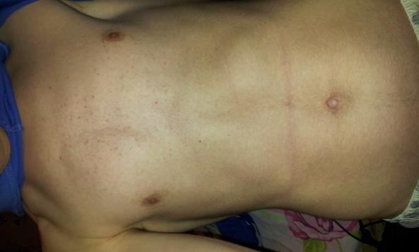 Was Tun Gegen Pickel Akne Rote Punkte Auf Der Brust