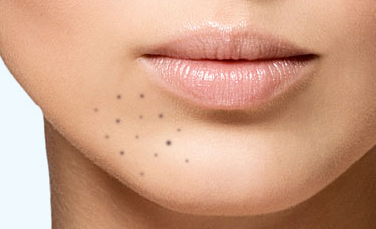 Was Tun Gegen Pickelmale Kleine Braune Flecken Im Gesicht Haut Pickel Hautpflege