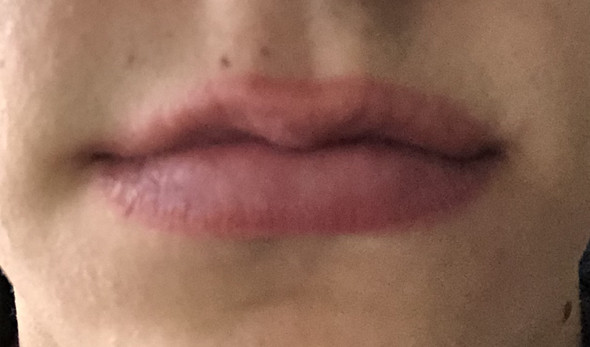 Was Tun Gegen Rotung Um Die Lippen Gesundheit Und Medizin Krankheit Lippe Was Tun Gegen Rotung Um Die Lippen Gesundheit Und Medizin Krankheit Lippe