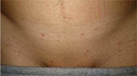 Was Tun Gegen Rotungen Entzundungen Nach Haarentfernung Sugaring Im Intimbereich Entzundung Was Tun Gegen Rotungen Entzundungen Nach Haarentfernung Sugaring Im Intimbereich Entzundung