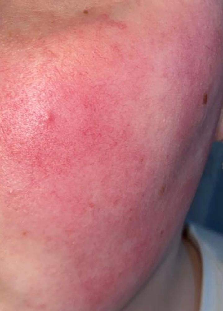 Was tun gegen rote Wangen? (Haut, Make-Up, Hautpflege)