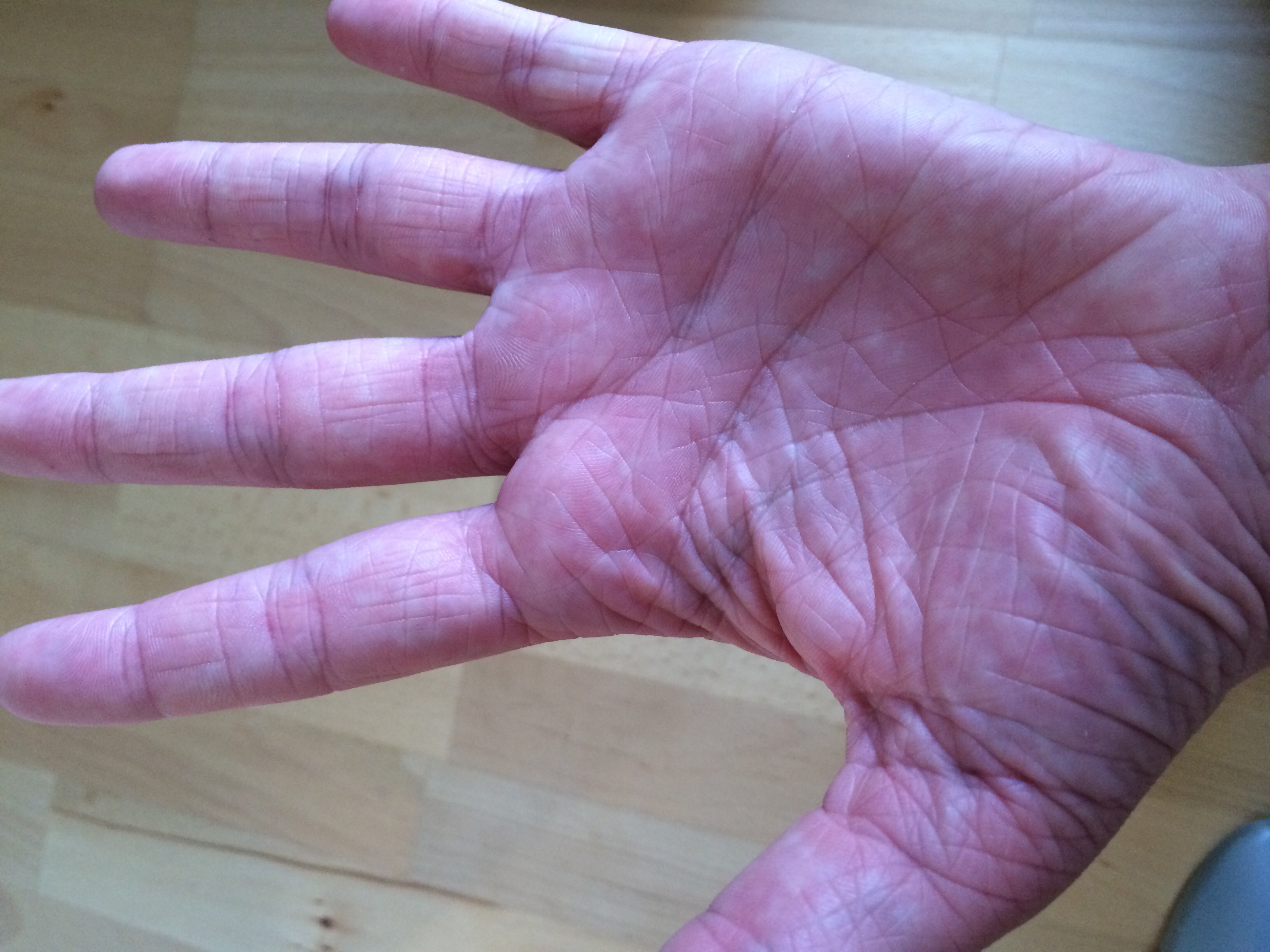 Was tun gegen schrumpelige Hände? Von Geburt veranlagt? (Medizin, Körper, Arzt)