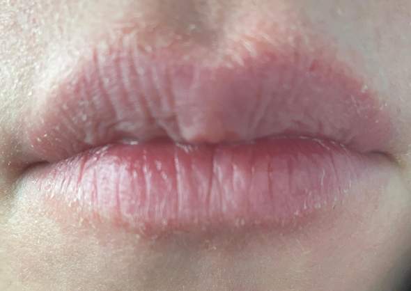 Was tun gegen sehr trockene/rissige Lippen?