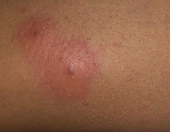 pickel am po mann pickel am po mann