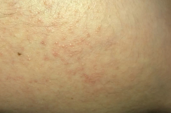 Was Tun Gegen So Welche Pickel An Den Wangen Rotungen Im Gesicht Was Tun Gegen So Welche Pickel An Den Wangen Rotungen Im Gesicht