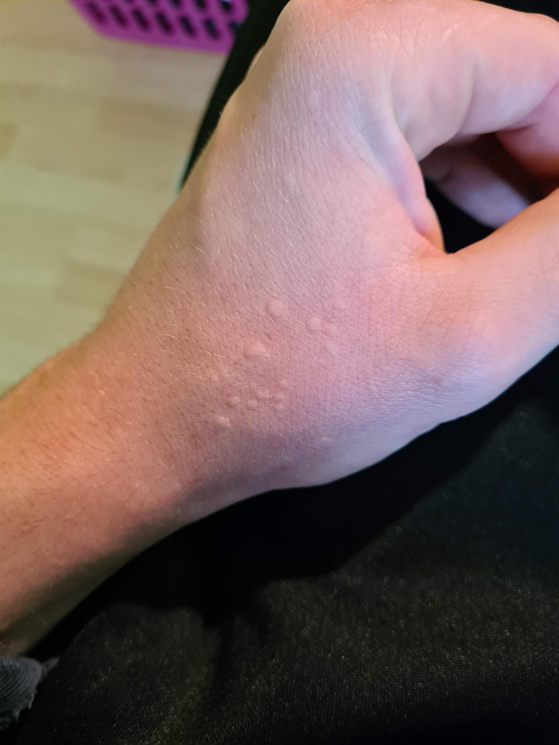 Was tun gegen solche Bläschen an der Hand? (Gesundheit und Medizin)