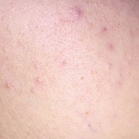 pickel an wangen pickel an wangen