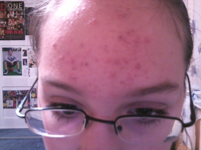 Was tun gegen vermehrte Pickel auf der Stirn? pickel an der stirn ursache