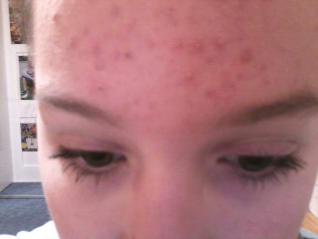 pickel an der stirn ursache