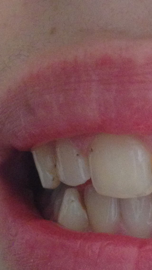 Was Tun Gegen Zahnverfarbungen Zahne Zahnpflege Mundhygiene Was Tun Gegen Zahnverfarbungen Zahne Zahnpflege Mundhygiene