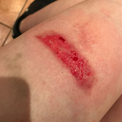 - (Blut, Wunde)