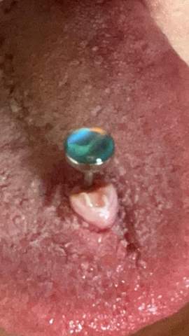 Was wächst an meinem Zungenpiercing?