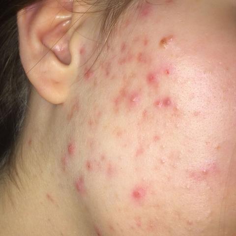 Was Wird Beim Hautarzt Gemacht Akne