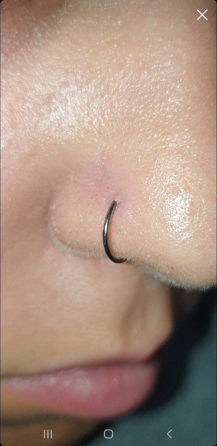 Was würdet ihr tun wenn der Nostril so aussieht? (Piercing, Entzündung