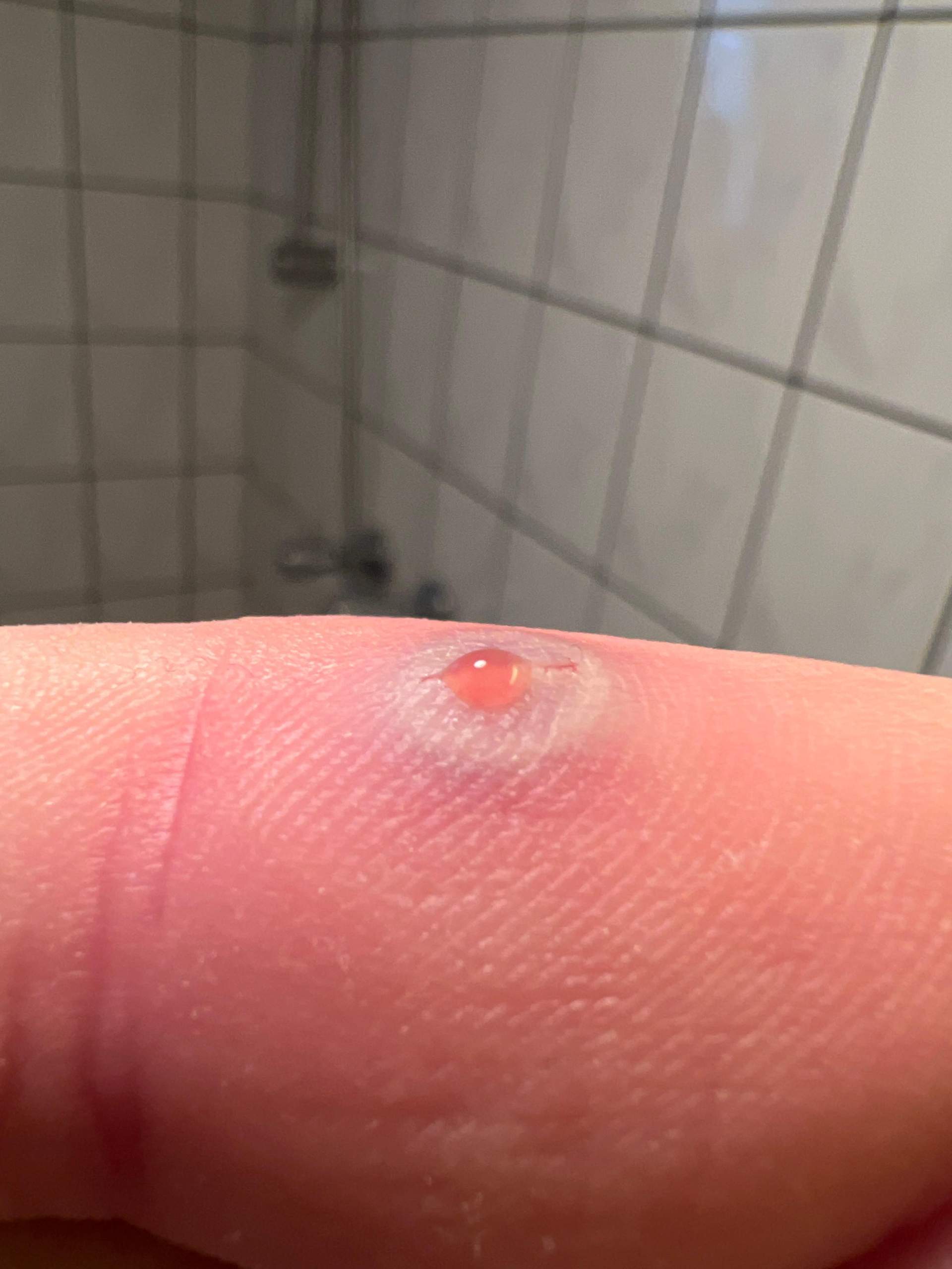 Was zu tun, Blase Finger Geschwollen? (Gesundheit und Medizin, Gesundheit)