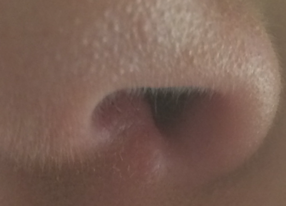 Was Zur Holle Ist Das An Meiner Nase Blase