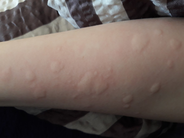 Wass Ist Das Hautausschlag Allergie Gesundheit Und Medizin Haut Juckreiz Wass Ist Das Hautausschlag Allergie Gesundheit Und Medizin Haut Juckreiz