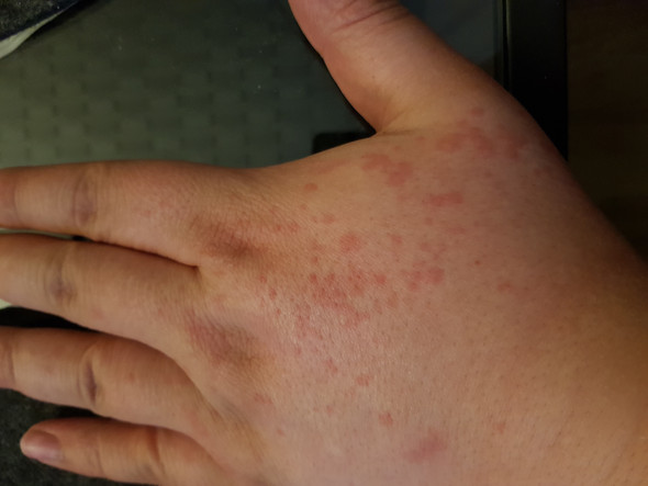 Wass Kann Das Sein Rote Juckende Punkte Auf Dem Handrucken Gesundheit Und Medizin Gesundheit Hand Wass Kann Das Sein Rote Juckende Punkte Auf Dem Handrucken Gesundheit Und Medizin Gesundheit Hand