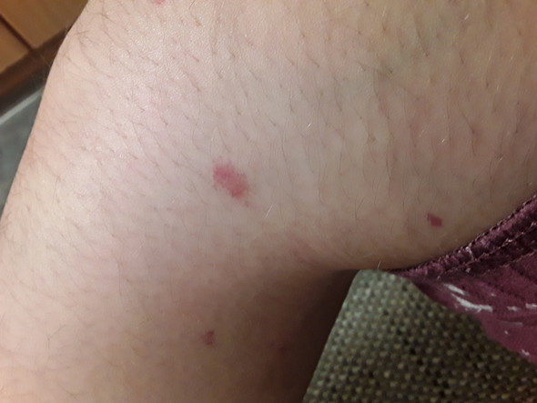 - (Gesundheit, Haut, Flecken)