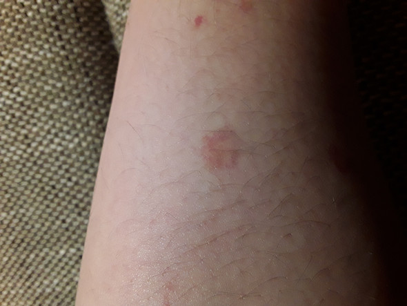 - (Gesundheit, Haut, Flecken)
