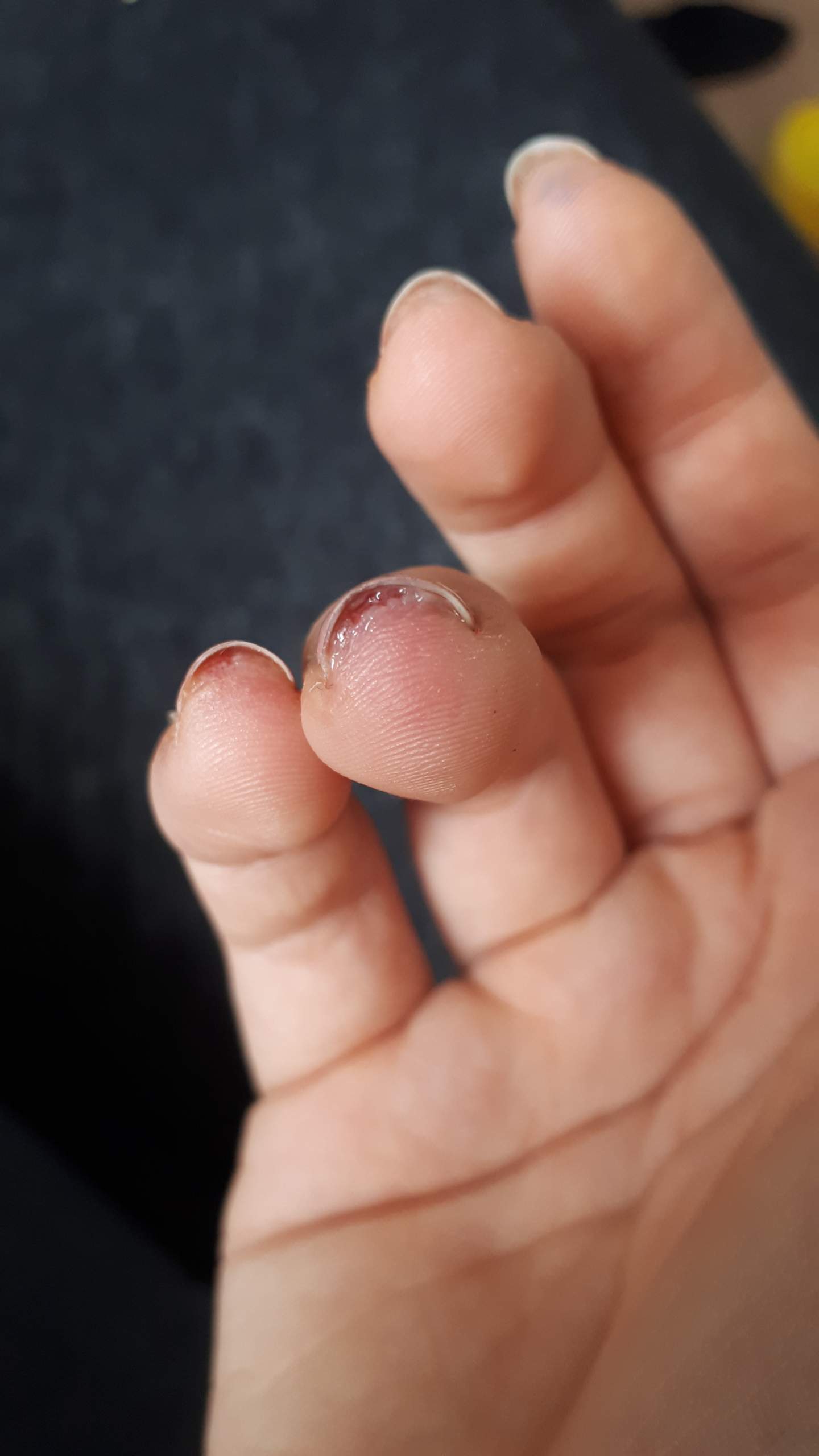 Wasser unter dem Nagel? (Gesundheit und Medizin, Nägel) Wasser unter dem Nagel? (Gesundheit und Medizin, Nägel)