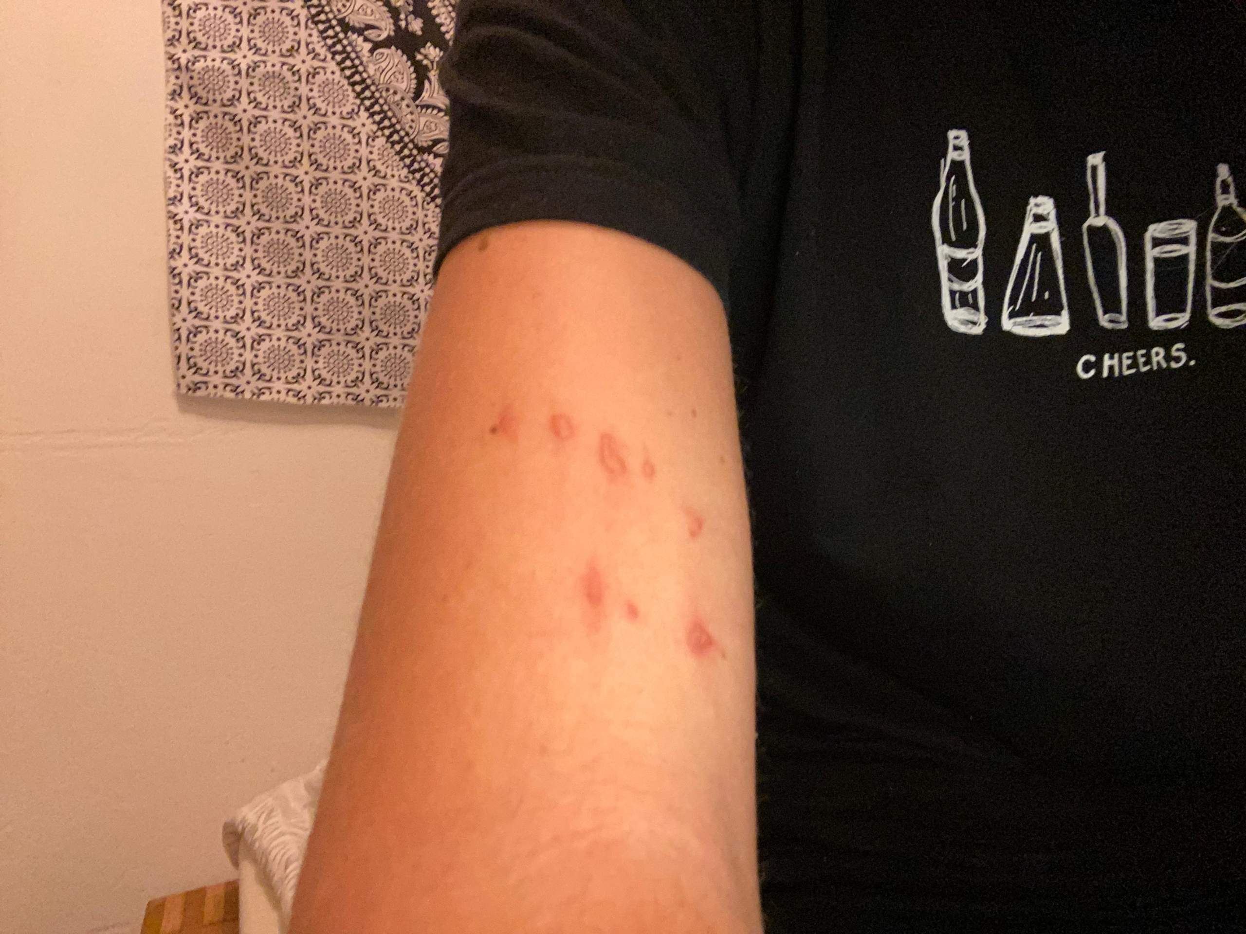 Wasserbläschen am Arm. Was ist das? (Gesundheit und Medizin, Hautarzt)