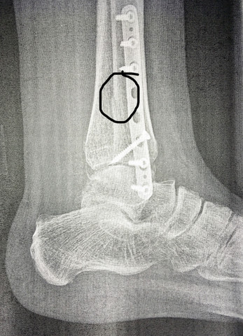 Weber B Fraktur Knochen Schief Zusammengewachsen Gesundheit Und Medizin Gesundheit Medizin Weber B Fraktur Knochen Schief Zusammengewachsen Gesundheit Und Medizin Gesundheit Medizin