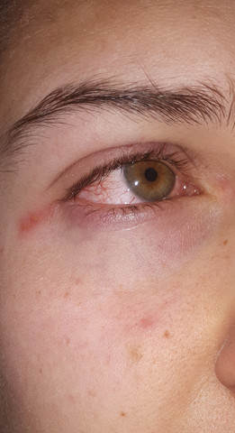 Wegen Herpes Ins Krankenhaus Augen Augenarzt Sehstorung