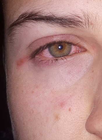 Wegen Herpes Ins Krankenhaus Augen Augenarzt Sehstorung Wegen Herpes Ins Krankenhaus Augen Augenarzt Sehstorung