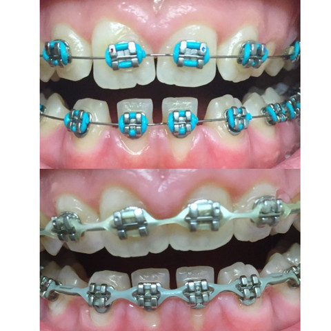 Meine Zähne  - (Zahnspange, Zahnfleisch, Kieferorthopädie)
