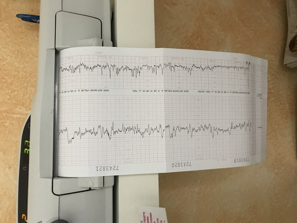 Wehentatigkeit 40 4 Ssw Schwangerschaft Wehentatigkeit 40 4 Ssw Schwangerschaft