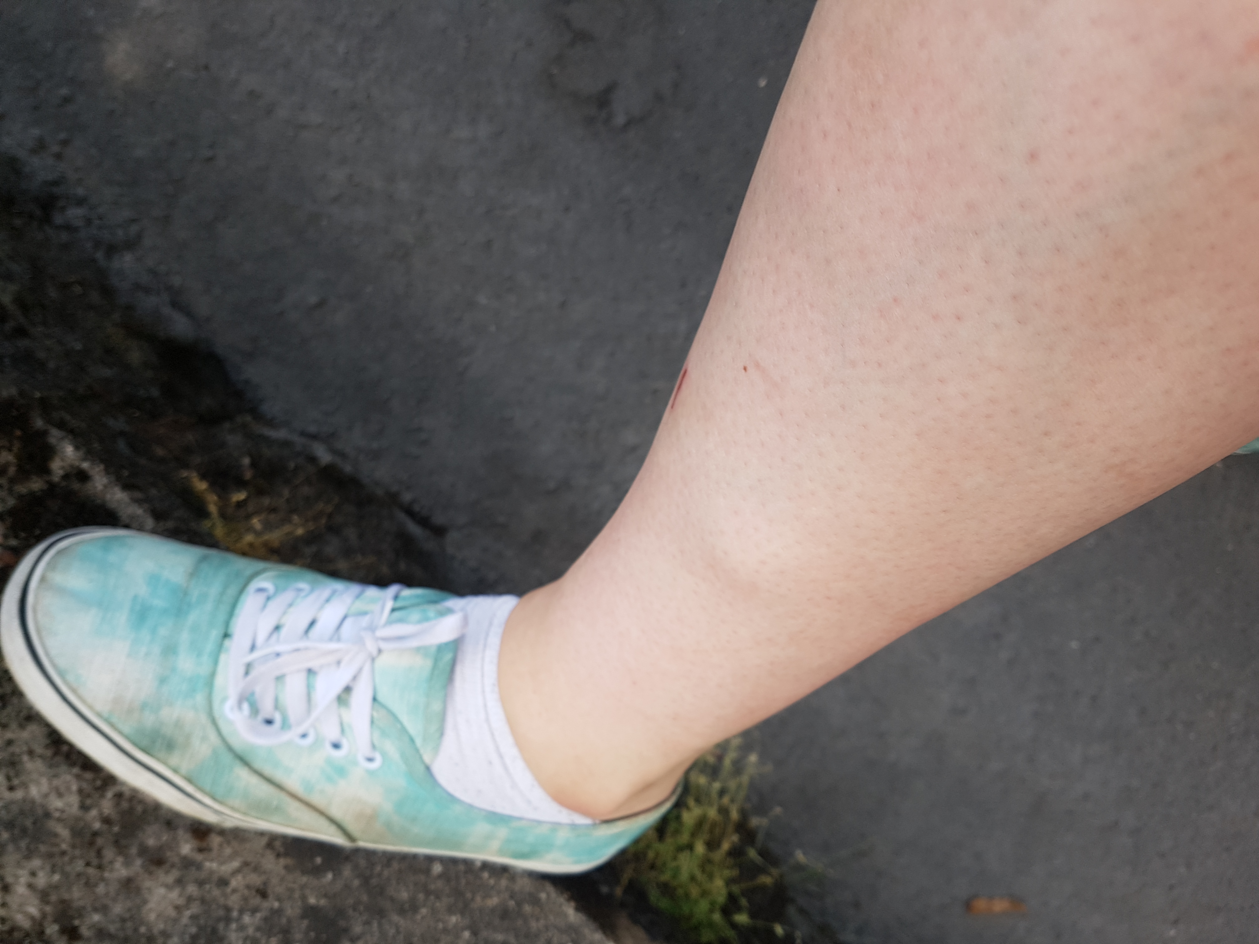 Weiche Beule Am Linken Schienbein Aussen Medizin Arzt Schmerzen Weiche Beule Am Linken Schienbein Aussen Medizin Arzt Schmerzen