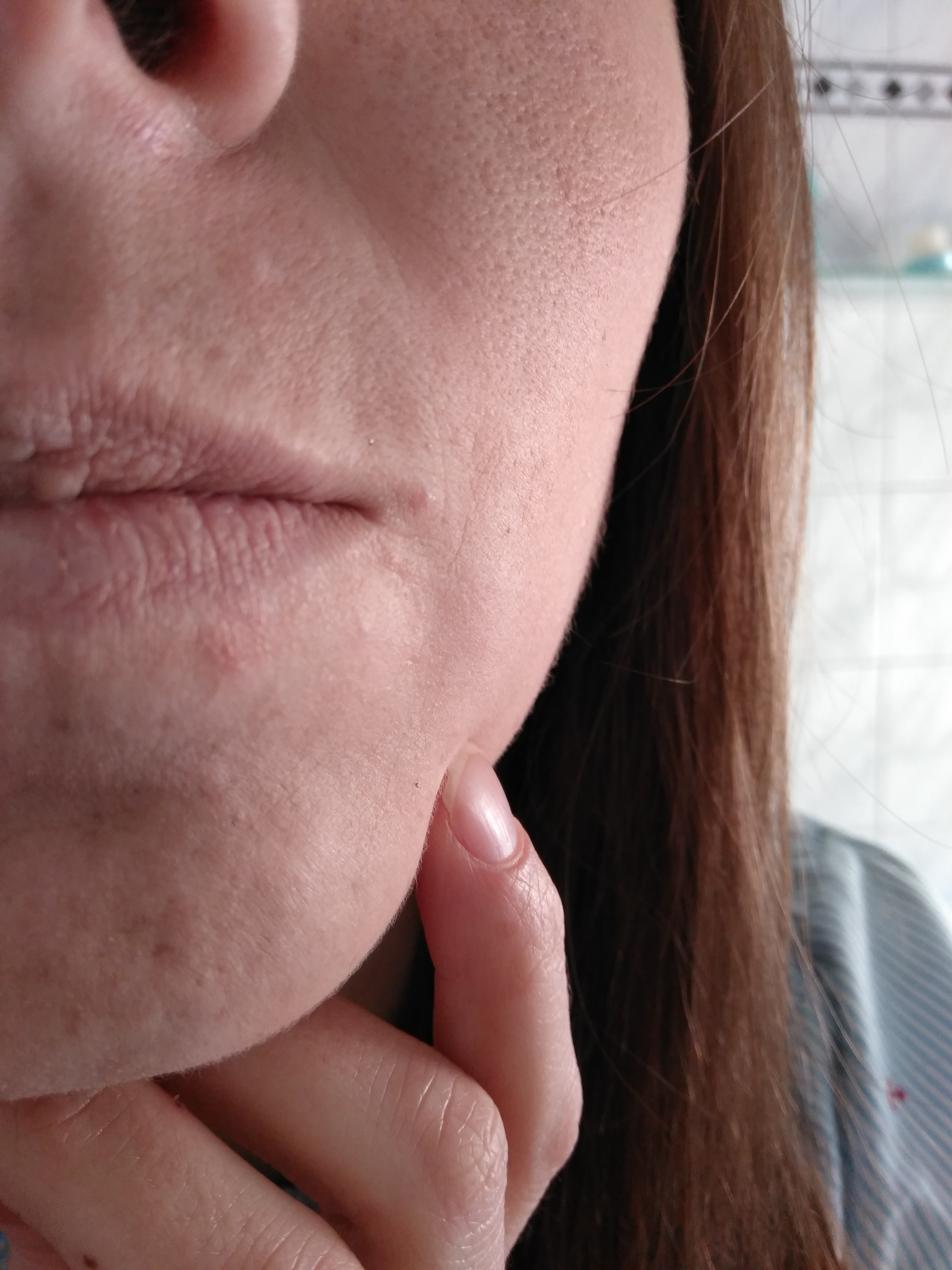 Weis Jemand Ob Das Periorale Dermatitis Ist Medizin Krankheit Haut Weis Jemand Ob Das Periorale Dermatitis Ist Medizin Krankheit Haut