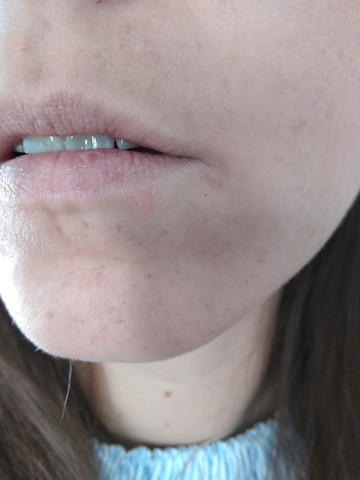 Weis Jemand Ob Das Periorale Dermatitis Ist Medizin Krankheit Haut Weis Jemand Ob Das Periorale Dermatitis Ist Medizin Krankheit Haut