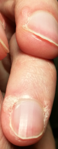 Haut - Finger - (Haut, Hautarzt, Finger)