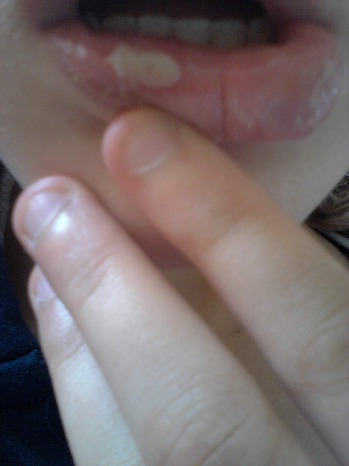 Weise Blase an der Lippe innen? Was tun?
