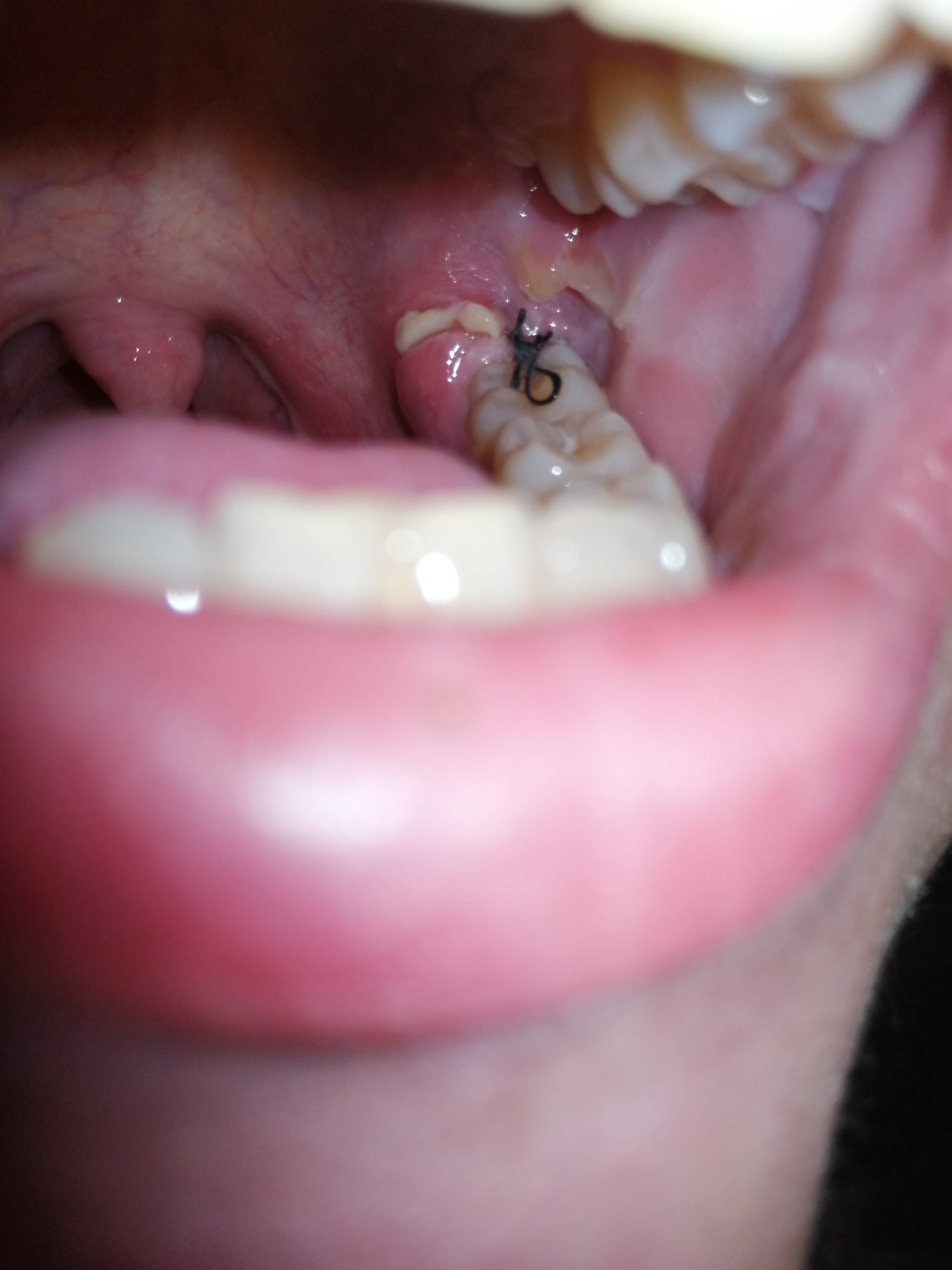 Weisheitszähne operation Entzündet? (Gesundheit und Medizin, Zähne, Entzündung) Weisheitszähne operation Entzündet? (Gesundheit und Medizin, Zähne, Entzündung)