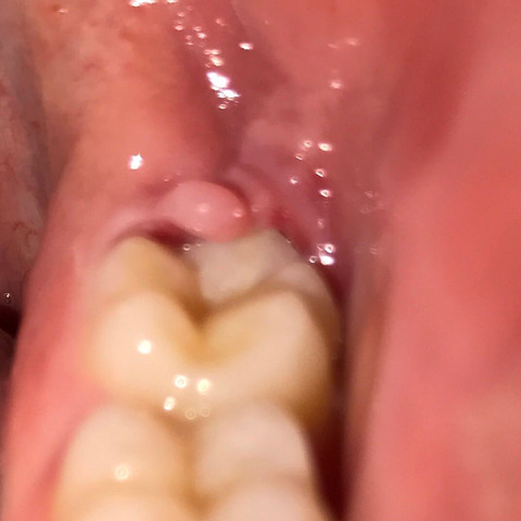 weisheitszahn unten links (8er)  - (Zahnarzt, Entzündung, Zahnfleisch)